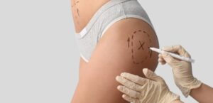 Person marking skin before non-surgical cosmetic procedure on buttocks