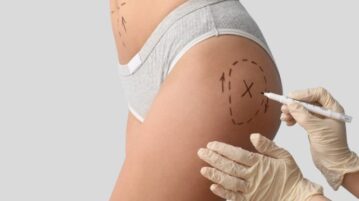 Person marking skin before non-surgical cosmetic procedure on buttocks